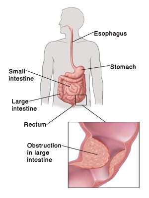 Large Bowel Obstruction | Veterans Affairs Outline of human figure showing digestive system and pointing out esophagus, small intestine, large intestine, and rectum. Detail of obstruction inside large intestine.