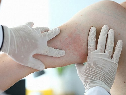 When is a drug rash more than just a rash? When is a drug rash more than just a rash?
