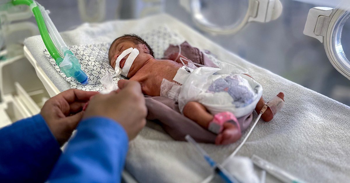 Without baby formula, some infants in Gaza are facing a slow death